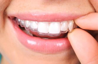 Invisalign Leeds patient