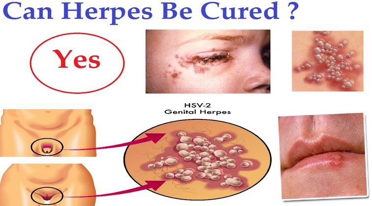 Picture of various types of herpes